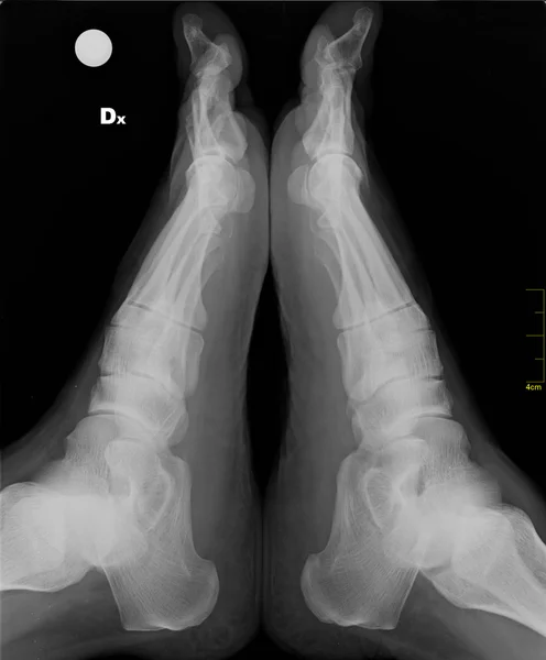 X-ray foot — Stock Photo, Image